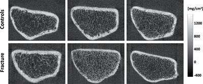 Global and Spatial Compartmental Interrelationships of Bone Density, Microstructure, Geometry and Biomechanics in the Distal Radius in a Colles’ Fracture Study Using HR-pQCT